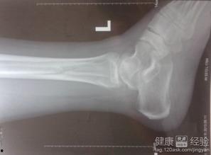 骨折可以吃角瓜,角瓜助力营养补充，加速骨骼愈合